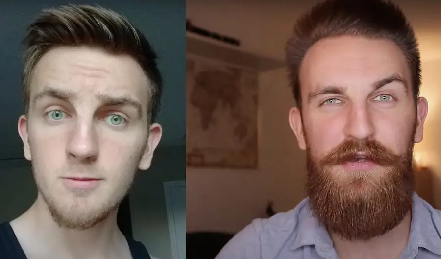 Does topical Minoxidil work for beard growth?